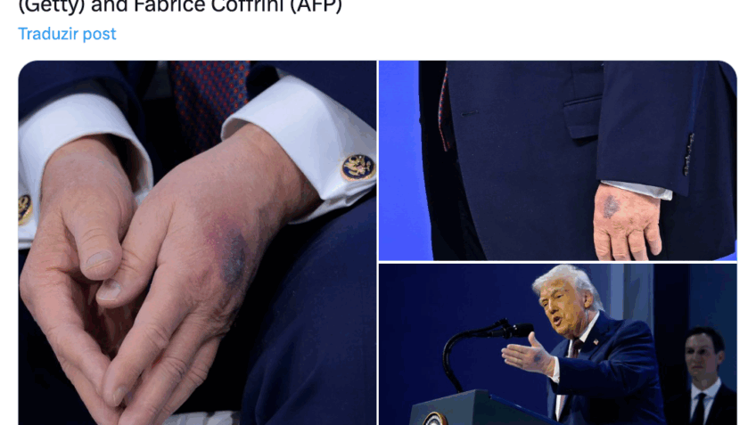 Trump aparece com novo hematoma na mão em evento em Davos
