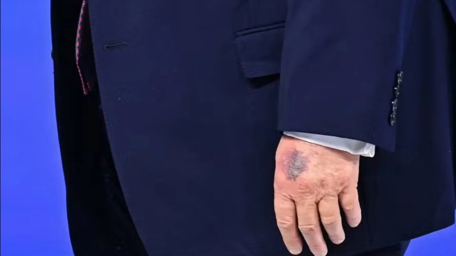 Hematoma misterioso na mão de Trump volta a chamar a atenção