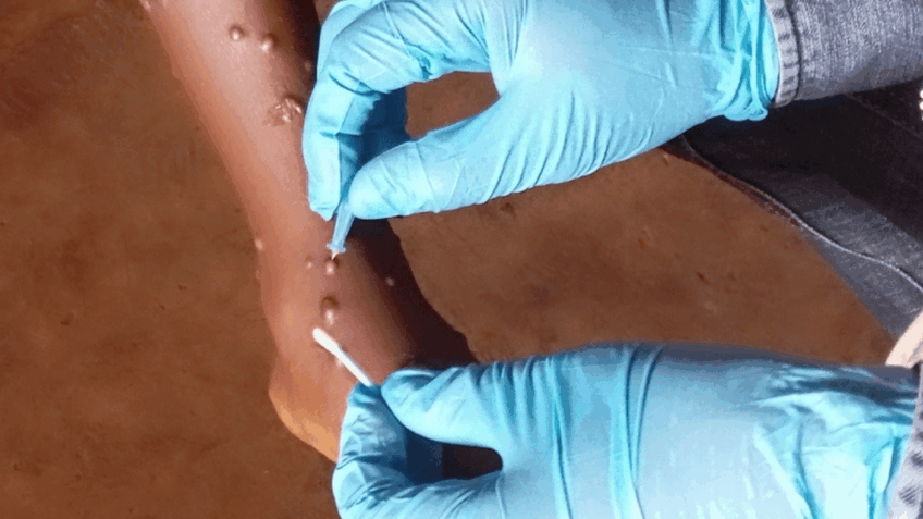 MG registra 2 novos casos de mpox e total chega a 17