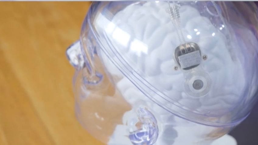 China libera uso comercial de implante cerebral para tetraplégicos